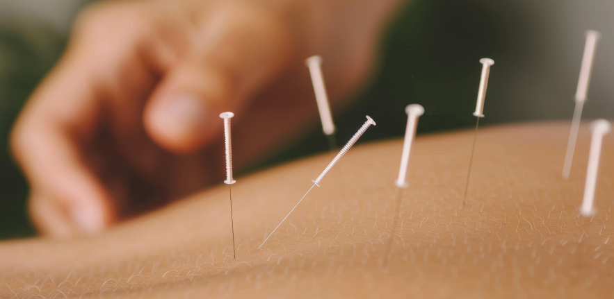 Acupuncture