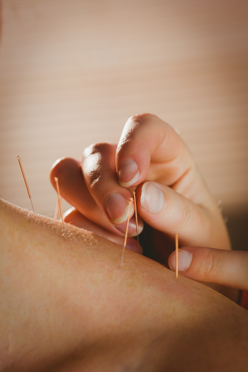 Acupuncture